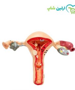 مولاژ بیماری‌های رحم